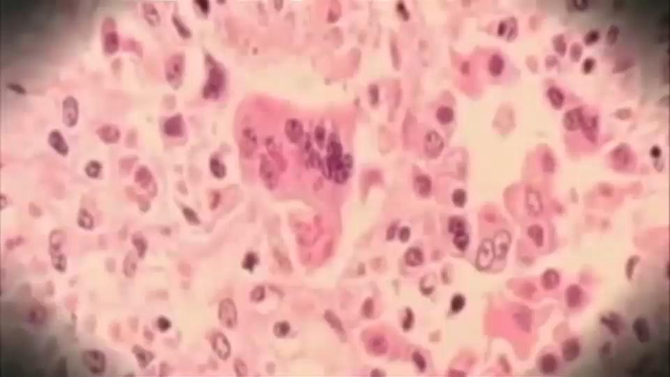 Travelers Warned After Measles Alert at Newark Airport