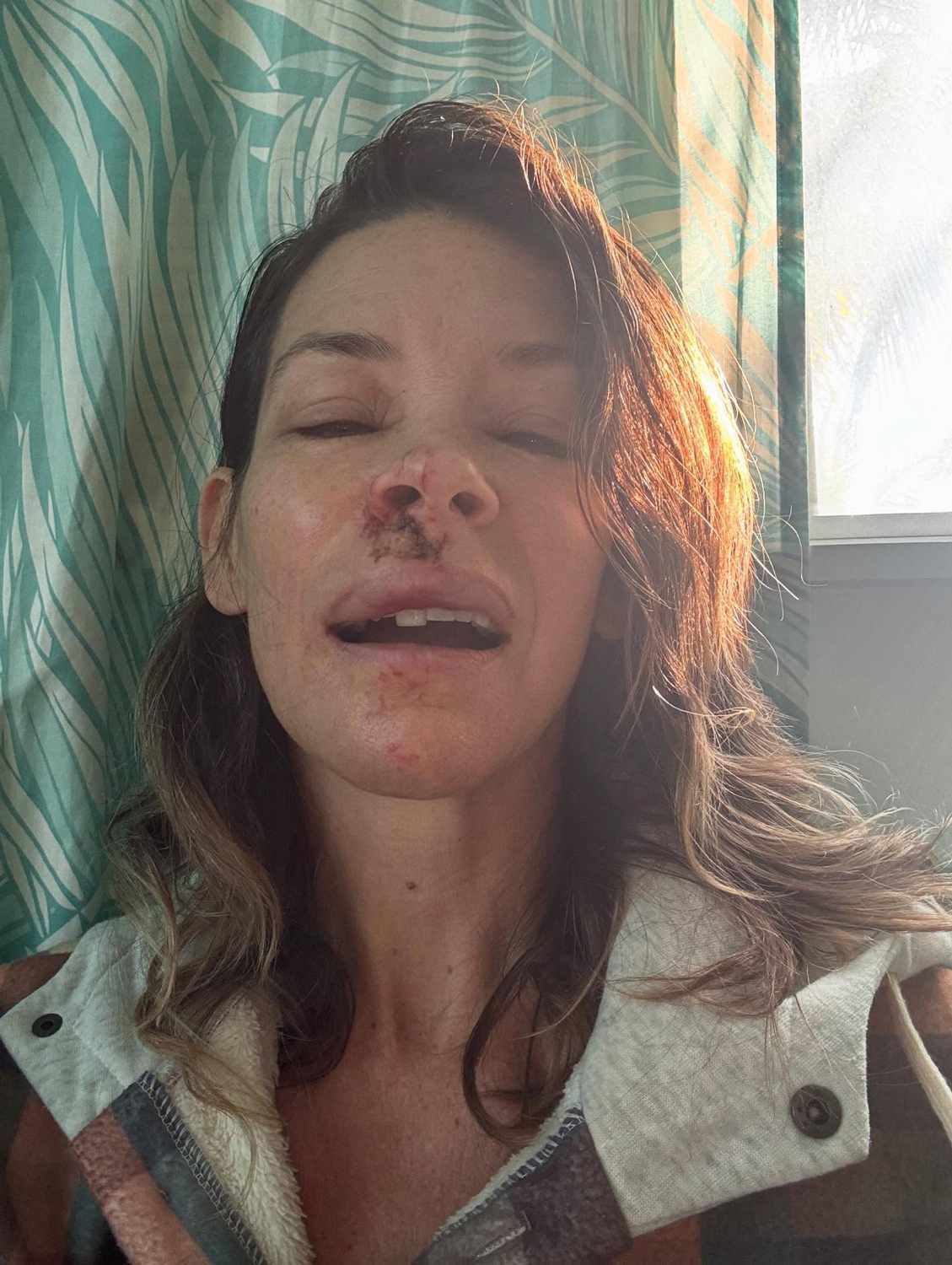 Evangeline Lilly Reveals Brain Damage After Beach Accident
